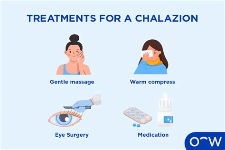 How long does a chalazion take to drain