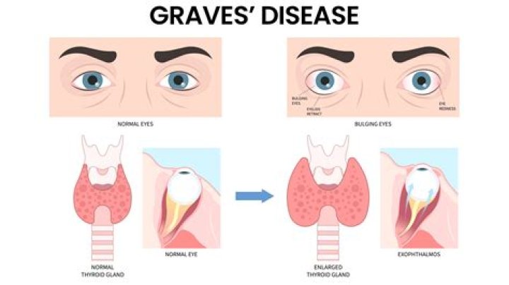 What condition does Maggie Smith have? What is Graves eye disease?
